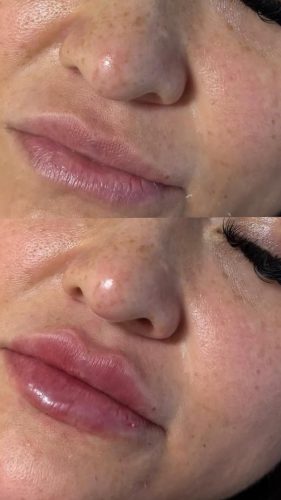 Dermalax Plus photo review