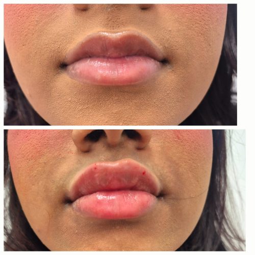 Dermalax Plus photo review