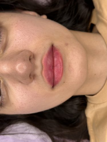 Dermalax Deep Plus photo review