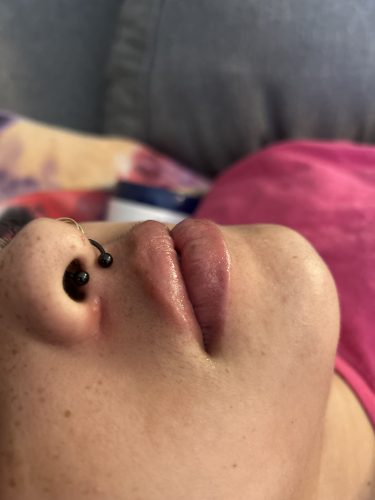 Dermalax Deep Plus photo review