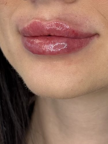 Dermalax Plus photo review