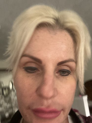 Dermalax Plus photo review