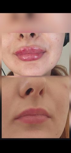 Rejeunesse Fine photo review