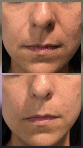 Neuramis Volume with Lidocaine photo review