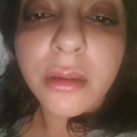 Neuramis Deep No Lidocaine photo review