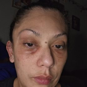 Liporase photo review