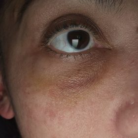 Liporase photo review