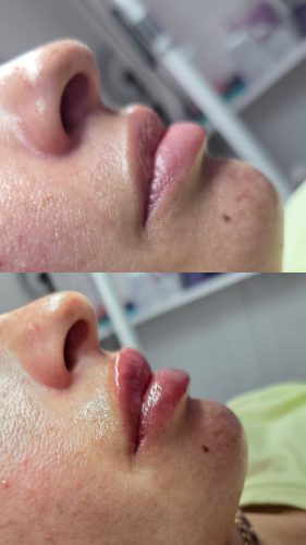 Replengen Fine photo review