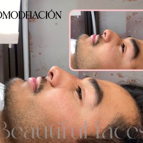 Celosome SOFT photo review