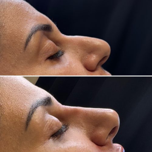 Dermalax Implant Plus photo review