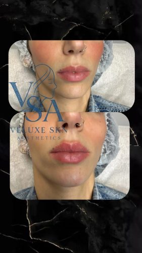 Replengen Fine photo review