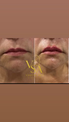 Replengen Fine photo review