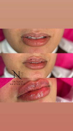 Rejeunesse Shape photo review