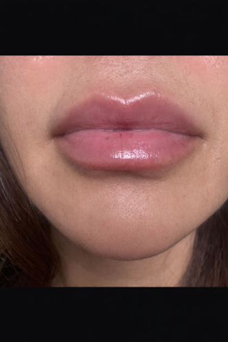 Click to view full screen Neuramis Deep with Lidocaine photo review