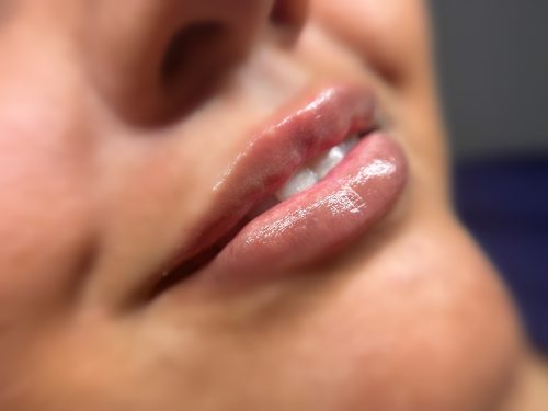 Dermalax Implant Plus photo review