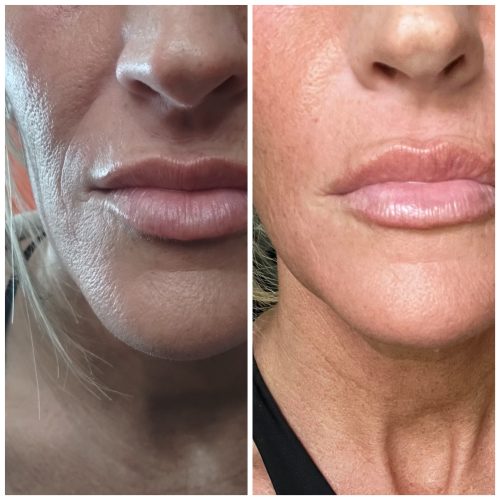 Dermalax Implant Plus photo review