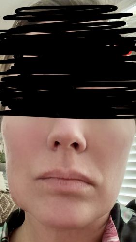 Neuramis Volume with Lidocaine photo review