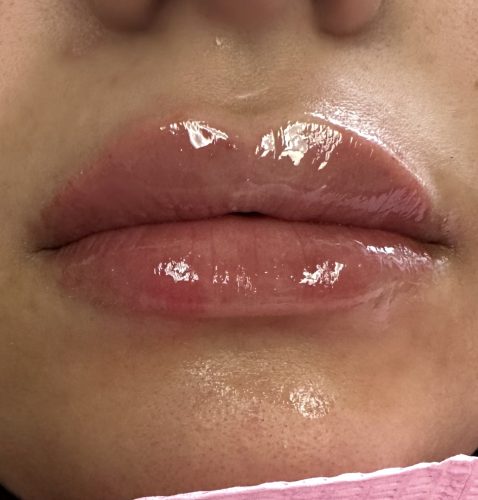 Neuramis Volume with Lidocaine photo review