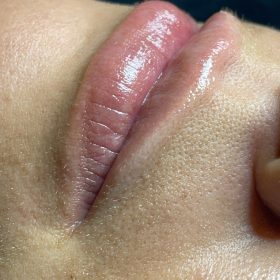 Dermalax Implant Plus photo review