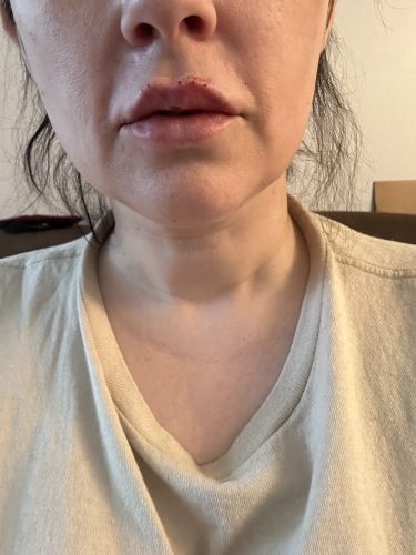 HyalDew Shine with Lidocaine photo review