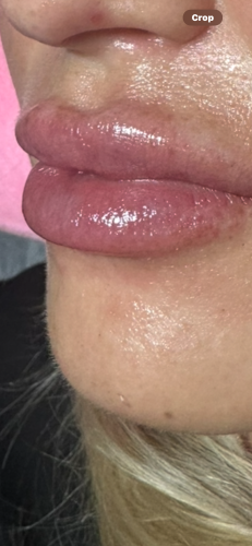 Neuramis Volume with Lidocaine photo review