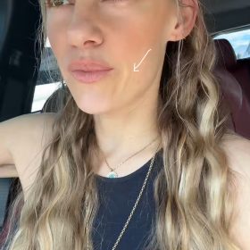 Liporase photo review