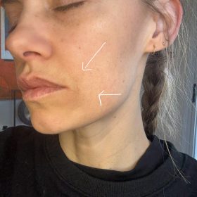 Liporase photo review