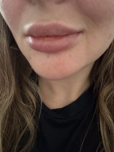 Dermalax Implant Plus photo review