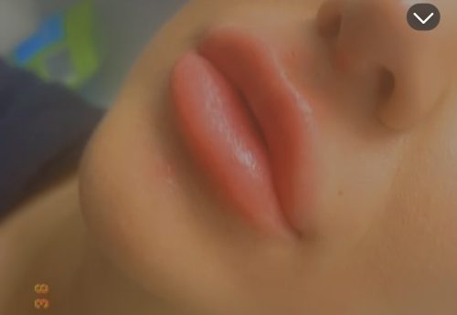 Neuramis Volume with Lidocaine photo review