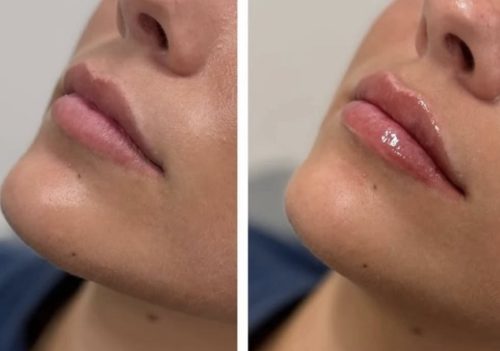 Replengen Fine photo review