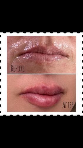 Neuramis Volume with Lidocaine photo review