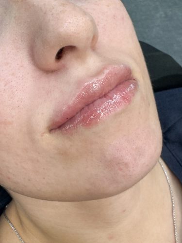 Replengen Fine photo review