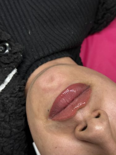 Neuramis Volume with Lidocaine photo review