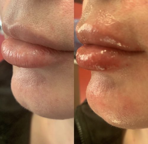 Neuramis Volume with Lidocaine photo review