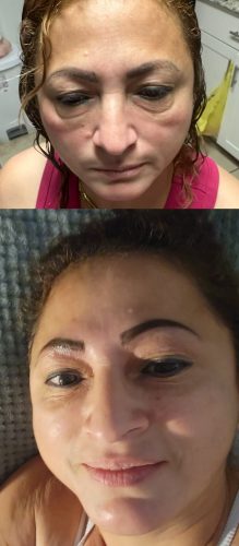 Replengen Fine photo review