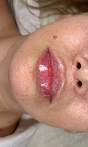 Replengen Fine photo review