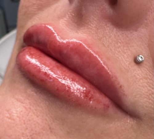 Replengen Fine photo review