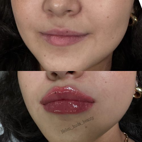 Revolax Sub-Q photo review