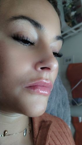 Dermalax Implant Plus photo review