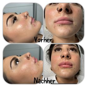 Revolax Deep photo review