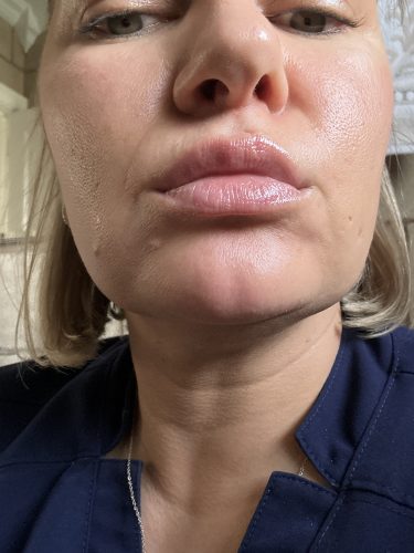 Rejeunesse Shape photo review