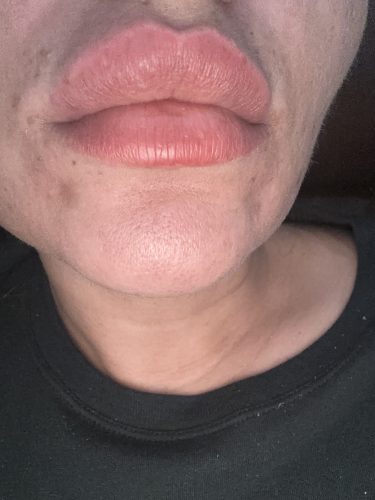 Neuramis Volume with Lidocaine photo review