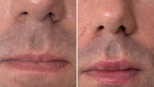 Celosome SOFT photo review