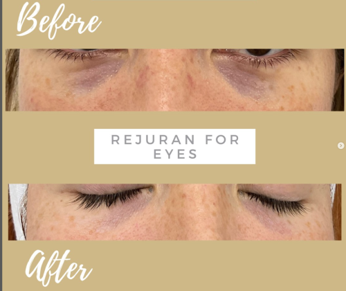 Rejuran i photo review