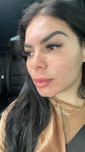 Rejuran i photo review