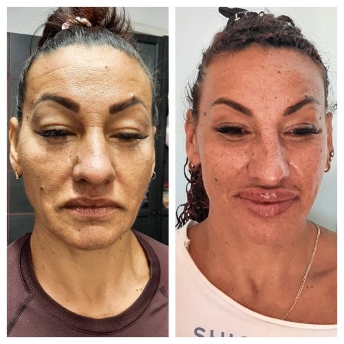 AestheFill photo review