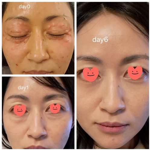 Rejuran i photo review