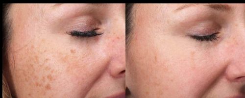 Rejuran S photo review