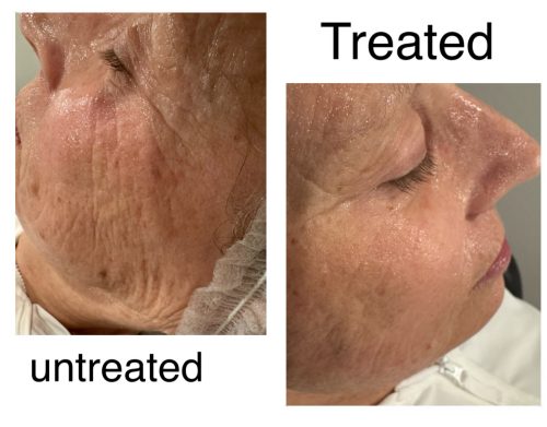 Rejuran i photo review