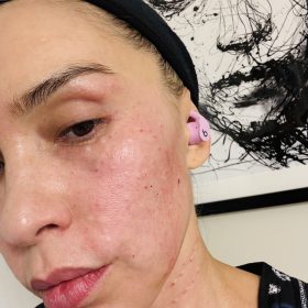 Rejuran HB photo review